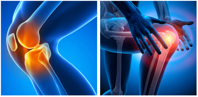 膝関節痛の図